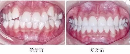 新品：整牙=換臉？隱適美IGO實(shí)現(xiàn)所有不可能！