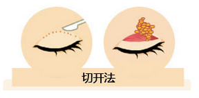 雙眼皮我想做埋線，為什么醫(yī)師建議我做全切雙眼皮