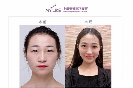 雙眼皮我想做埋線，為什么醫(yī)師建議我做全切雙眼皮