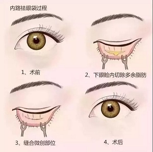 美萊實驗室：分型祛除眼袋，拒絕+10歲