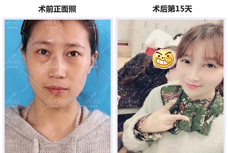 美萊實驗室：分型祛除眼袋，拒絕+10歲