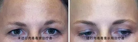 你無(wú)法用玻尿酸除掉所有皺紋！