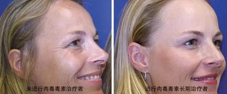 你無(wú)法用玻尿酸除掉所有皺紋！