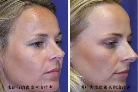 你無(wú)法用玻尿酸除掉所有皺紋！