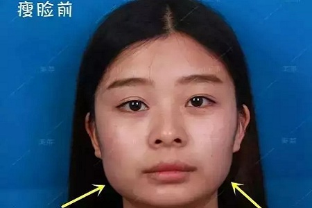 瘦臉針會導致臉部凹陷松弛？