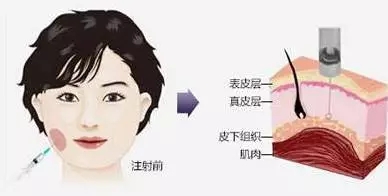 瘦臉會導致臉部凹陷松弛？