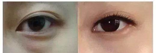 每到放假，做這個項目的人就會增多！--眼袋