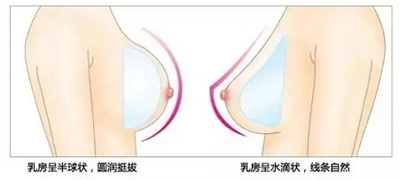 要不要隆胸，你對豐胸手術(shù)了解多少？
