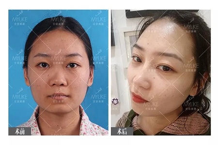 顏值：插座鼻變小翹鼻，就是這么神奇！