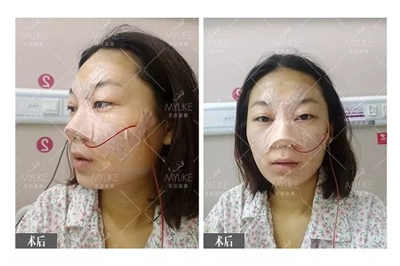 顏值：插座鼻變小翹鼻，就是這么神奇！