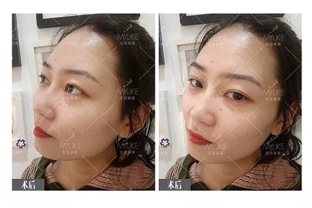 顏值：插座鼻變小翹鼻，就是這么神奇！