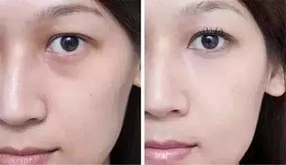 還把眼袋當(dāng)臥蠶？那就別怪小弟弟喊你阿姨了