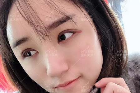自體脂肪+雙眼皮，這對cp你不pick一下嗎？