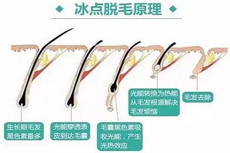 既便宜又安全的脫毛方法是什么？