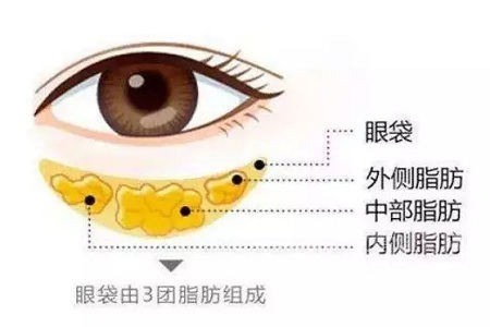 去掉眼袋，刻不容緩，別等又大又松弛才做
