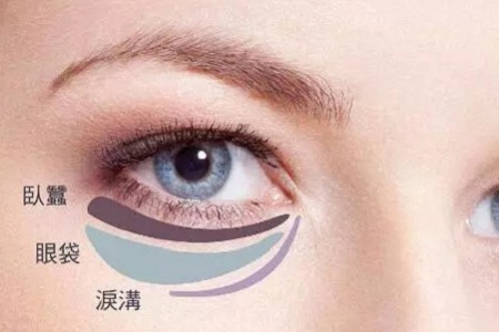 去掉眼袋，刻不容緩，別等又大又松弛才做