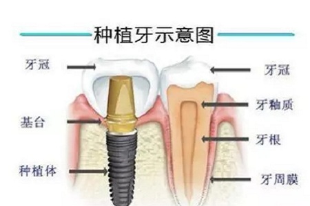 揭秘牙齒矯正的全過程?。?！