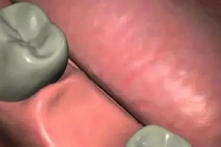 揭秘牙齒矯正的全過程！??！