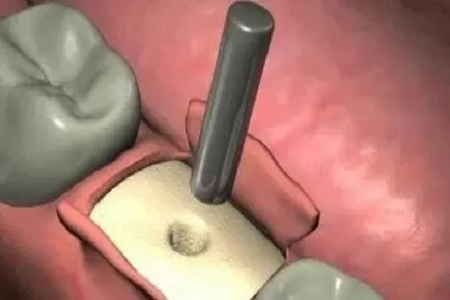 揭秘牙齒矯正的全過程?。?！