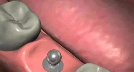 揭秘牙齒矯正的全過程?。?！