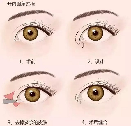 美萊實驗室：開眼角就是醫(yī)師想多收錢？