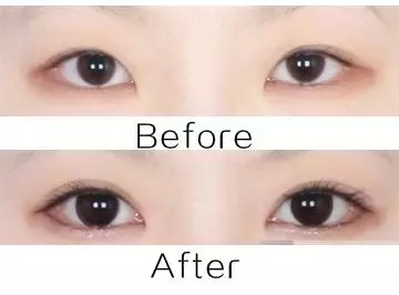 美萊實驗室：開眼角就是醫(yī)師想多收錢？
