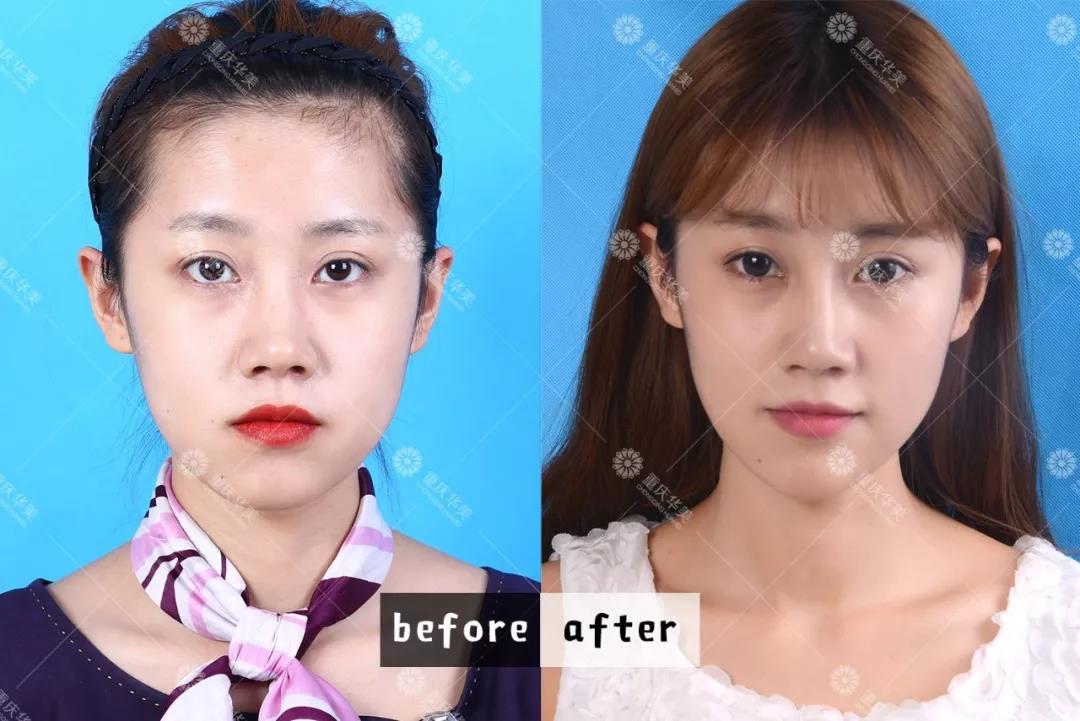 進口和國產(chǎn)瘦臉針有什么區(qū)別？2分鐘看懂