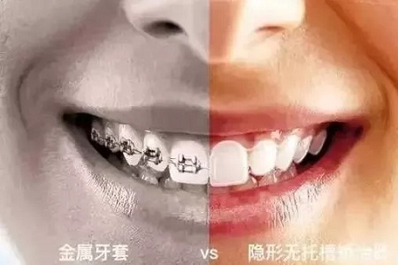 告別鋼牙妹——隱形矯正新時(shí)代，拯救尷尬的微笑！