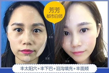 噓！你想不想隨心所欲的美？選擇玻尿酸吧！