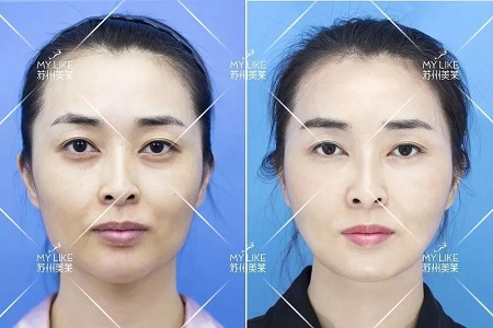 顯老淚溝，你還要任其放肆嗎？
