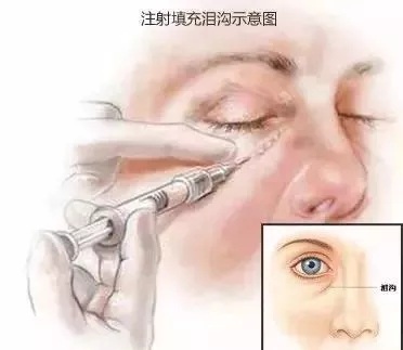 顯老淚溝，你還要任其放肆嗎？