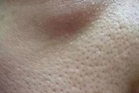 粗糙、毛孔粗大、起皮......換季肌膚問題如何解決？
