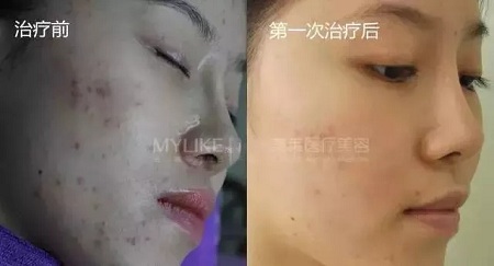 愛長痘痘的你，應該試試這道光！