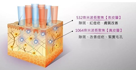 超皮秒激光祛斑，實(shí)力素顏，不加“斑”