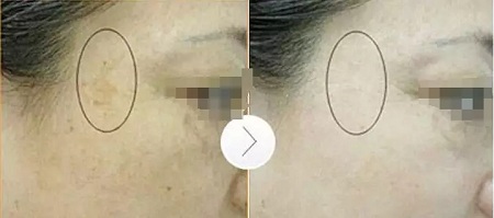 超皮秒激光祛斑，實(shí)力素顏，不加“斑”