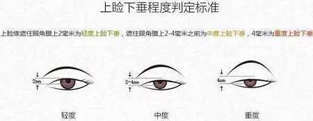 據(jù)說80%的亞洲女性都有這一眼部通病，上瞼下垂你了解過嗎？