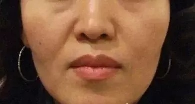用玻尿酸治療鼻唇溝，一定要注意這種情況！