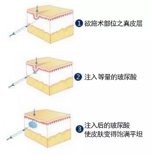 用玻尿酸治療鼻唇溝，一定要注意這種情況！