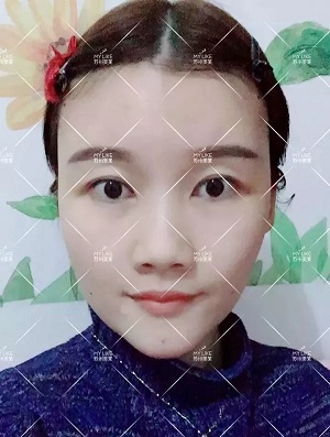 面部填充會不會把臉填大？