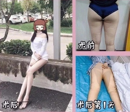 吸脂手術(shù)
