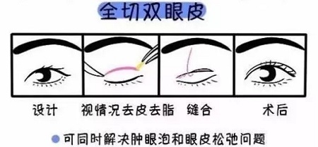 美眼張誠坐診美萊，淺談為什么你的眼睛不夠美？