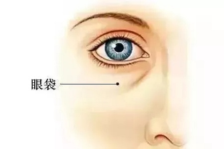 眼袋也分很多類型，看看你屬于哪一型？