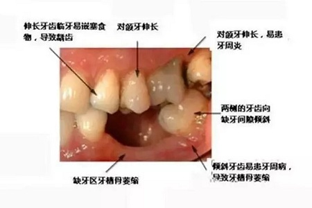 牙齒缺失時(shí)，選烤瓷牙還是那種？
