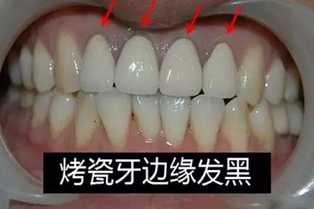 牙齒缺失時(shí)，選烤瓷牙還是那種？