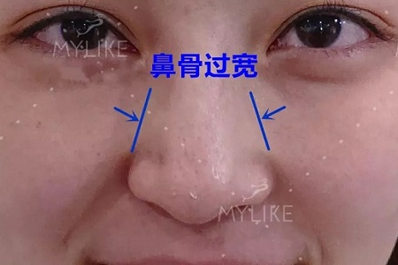 側(cè)面看鼻梁不矮,正面看鼻子卻很塌是什么原因？