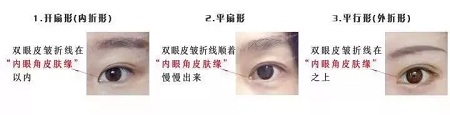 雙眼皮類(lèi)型