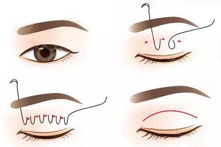 ?雙眼皮手術(shù)只聽過全切？還有哪些眼部手術(shù)方法？