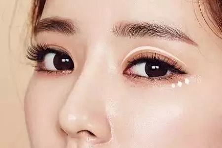 做雙眼皮，為什么醫(yī)生建議做開(kāi)眼角