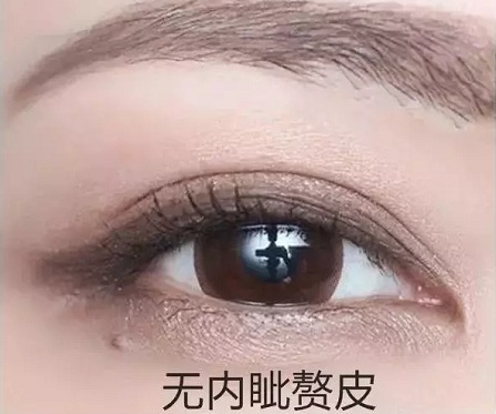 無(wú)內(nèi)眥贅皮