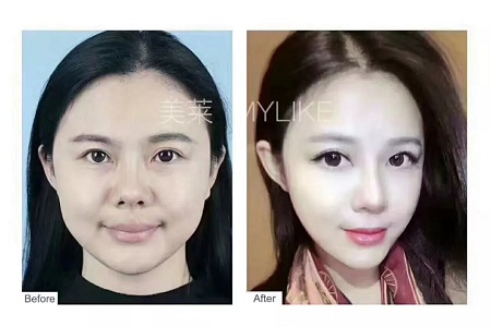 想抗衰，*雕和玻尿酸哪個更適合？